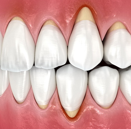 Closeup of patient with red gums
