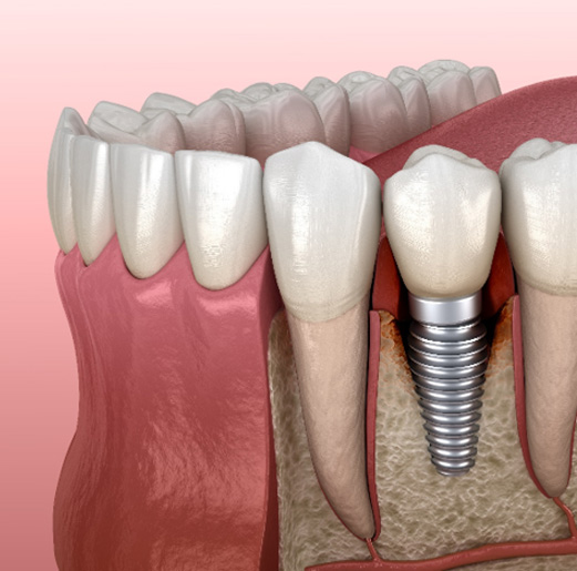 Illustration of bone loss around a dental implant