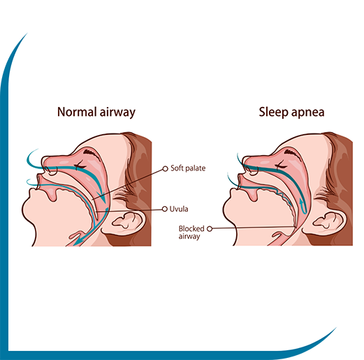 Illustration of an airway blocked by sleep apnea