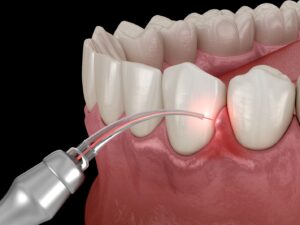 a dental laser treating inflamed gum tissue